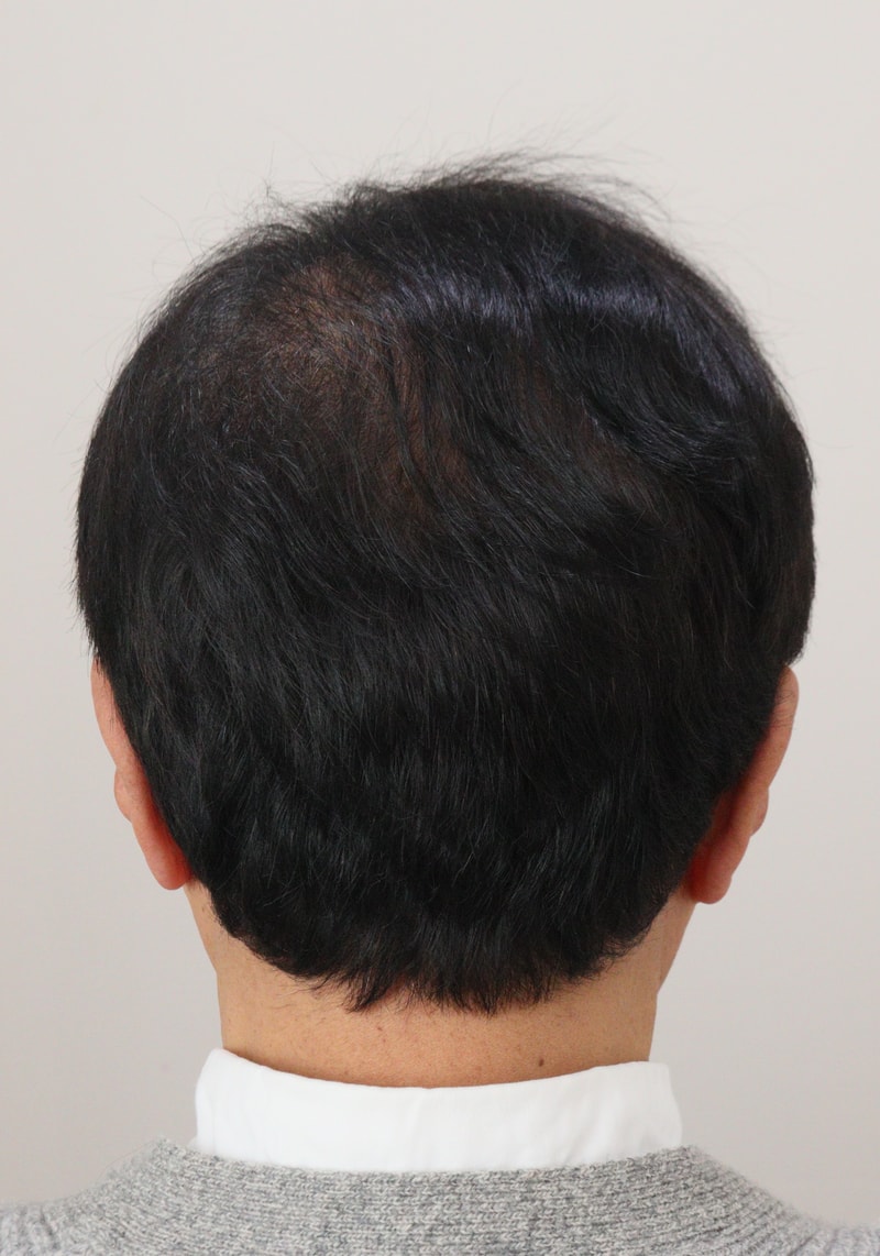 4. 수술후_1년_1.JPG