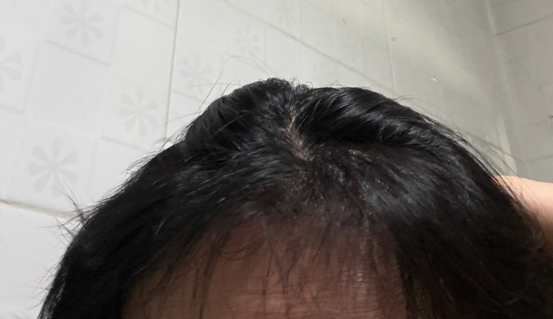 뉴헤어 절개 8개월 지난 후기