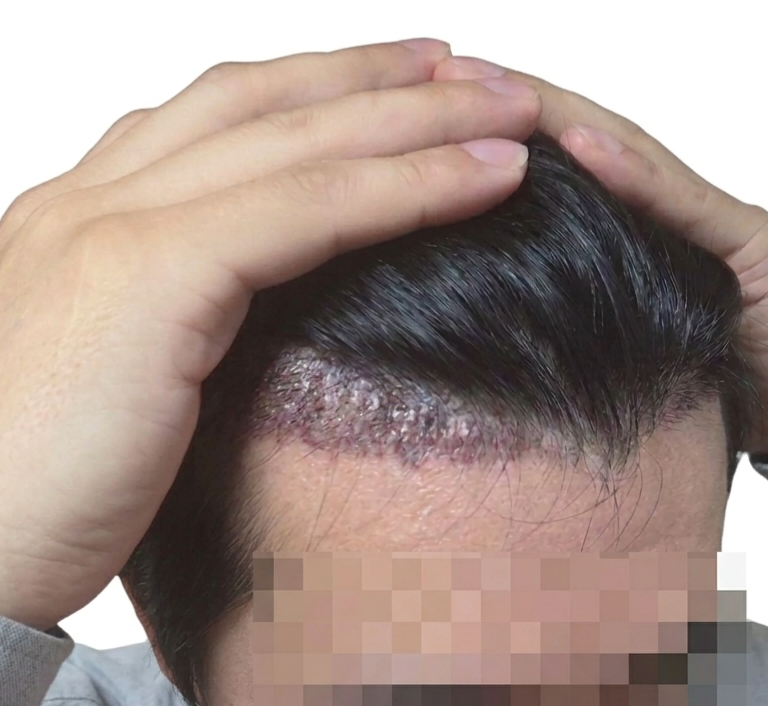 모발이식 (2).png