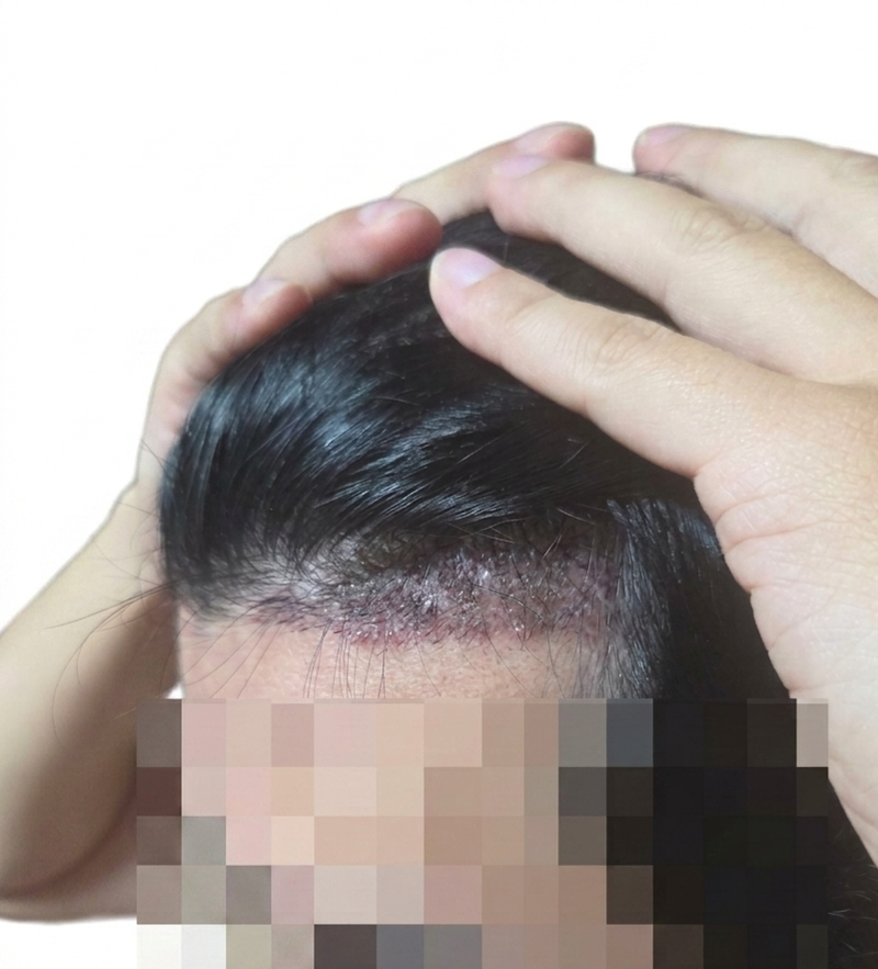 모발이식 (1).png