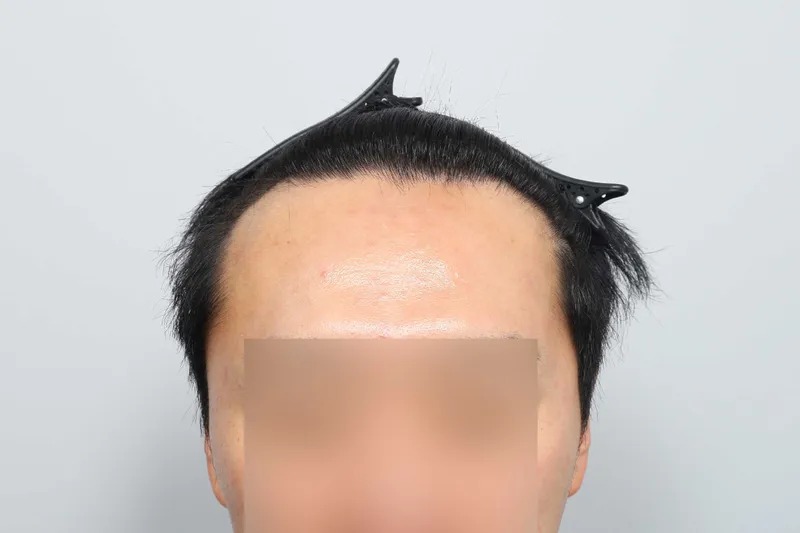 모원성형외과 정재홍원장님 헤어라인, 구렛나루 1850모낭 2주차 후기