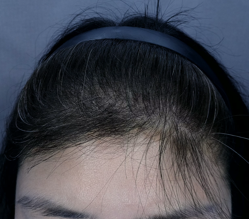 이식,관리,smp 헤어라인 후2.png