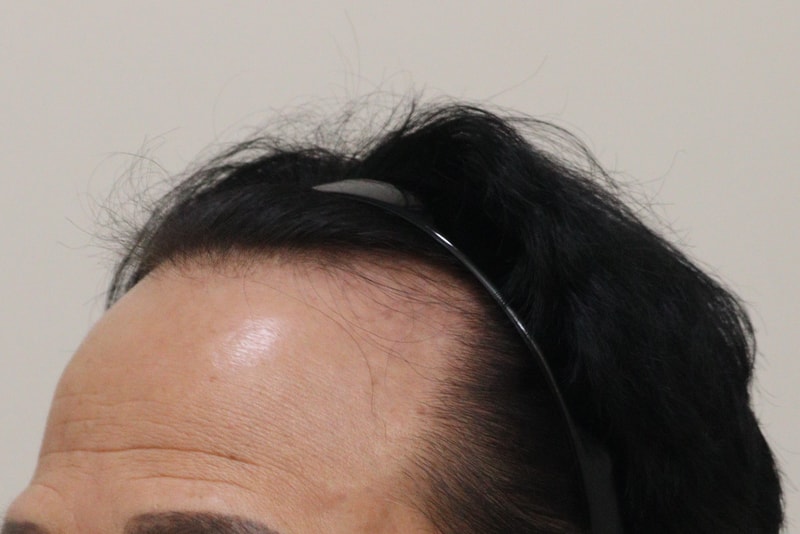 1. 수술전_2.JPG