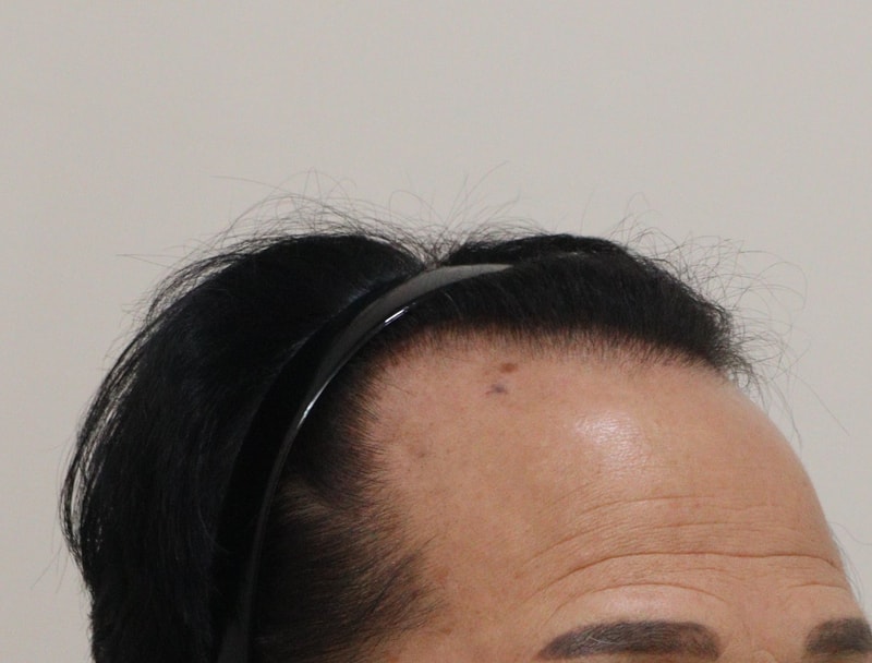 1. 수술전_3.JPG