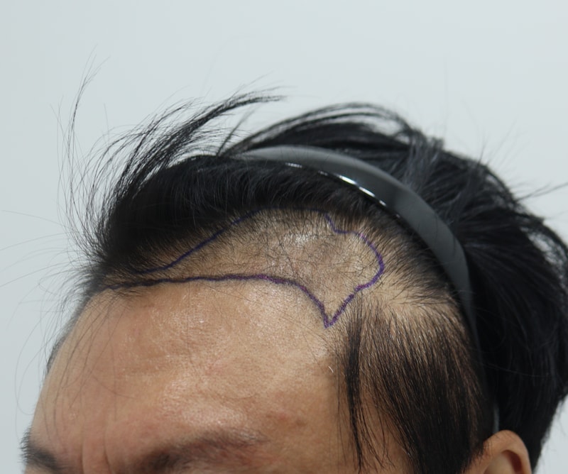 1. 수술전_3.JPG