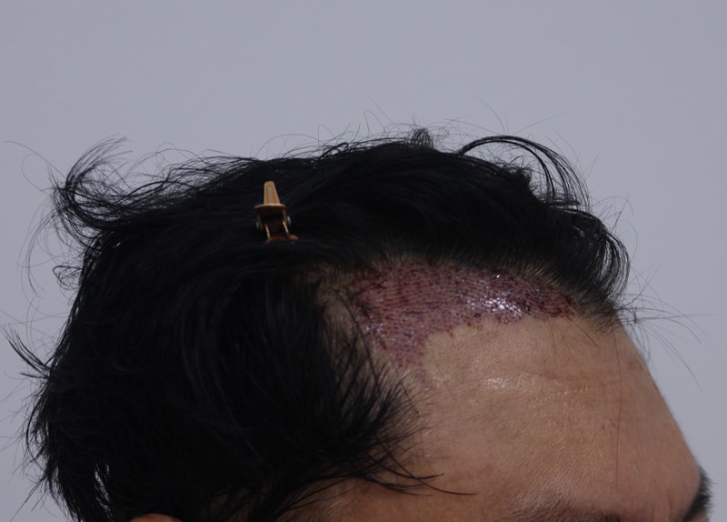 2. 수술후_1일_2.JPG