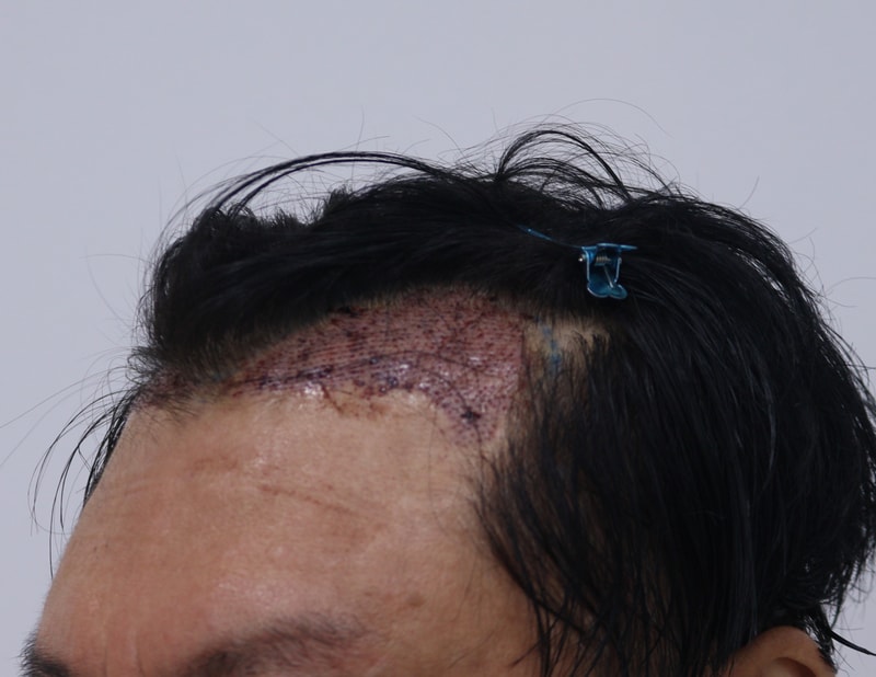 2. 수술후_1일_3.JPG