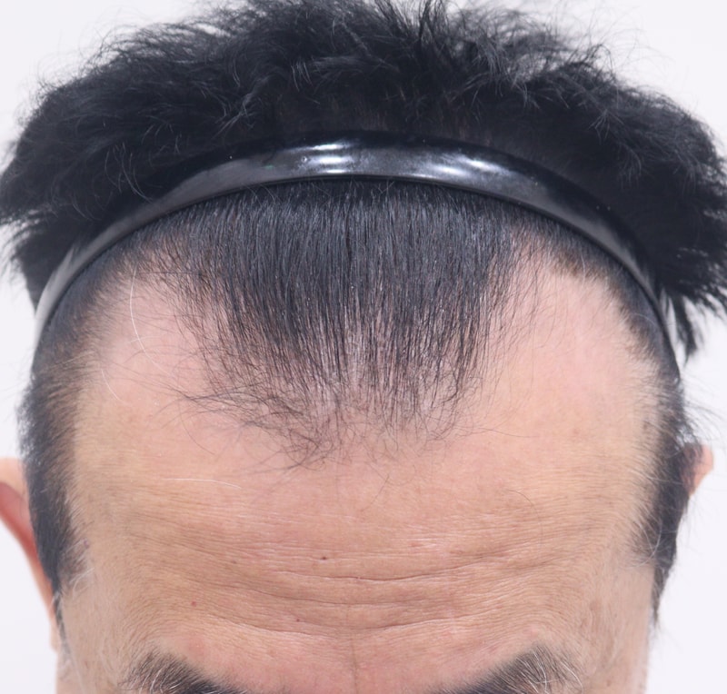 1. 수술전_2.JPG