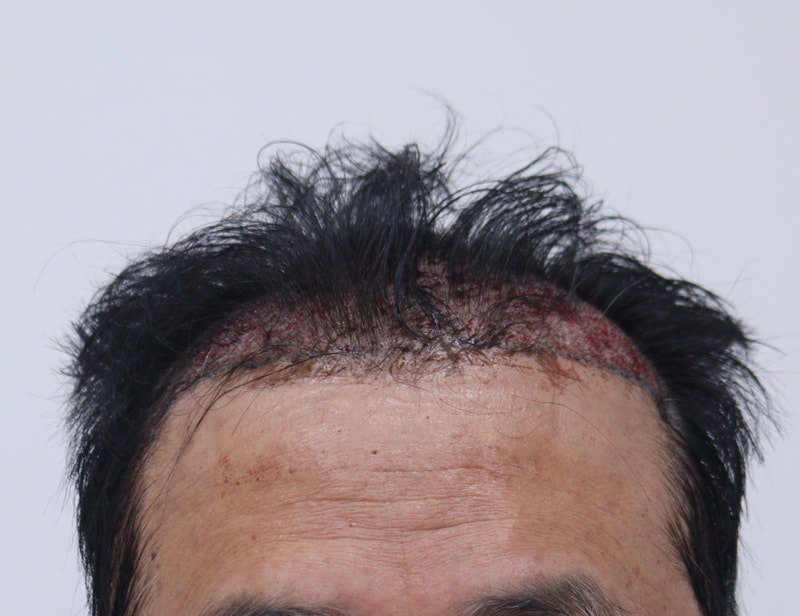 2. 수술후_1일_1.JPG