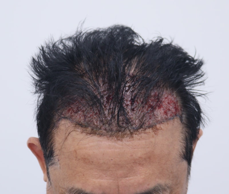 2. 수술후_1일_2.JPG