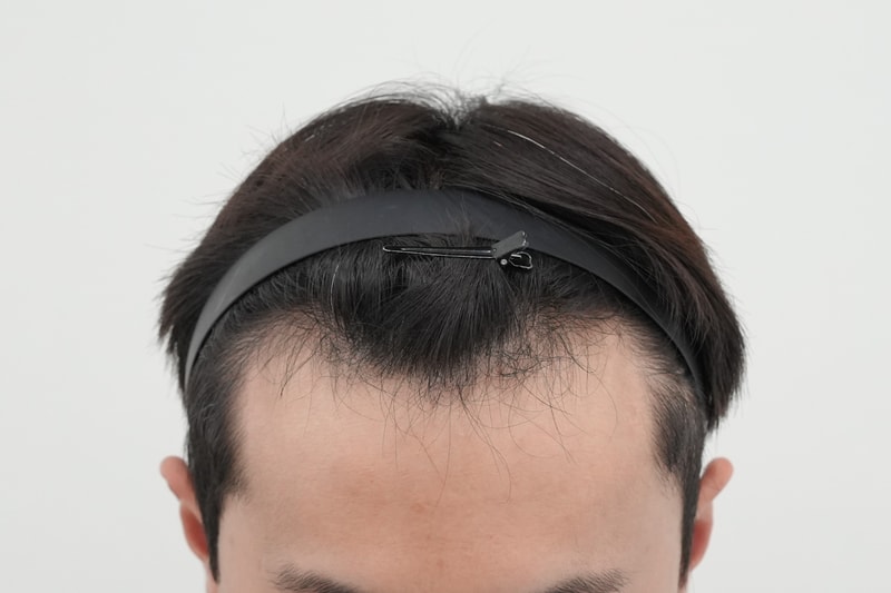 수술전.jpg