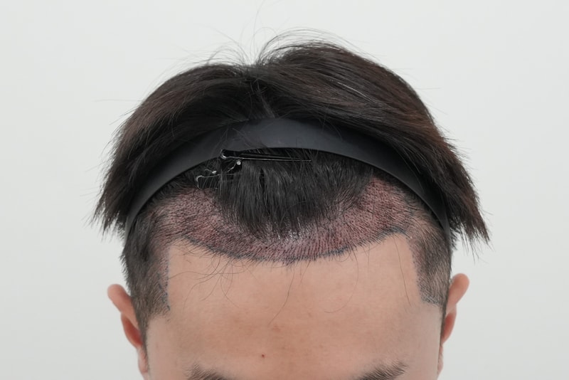 수술1일차.jpg
