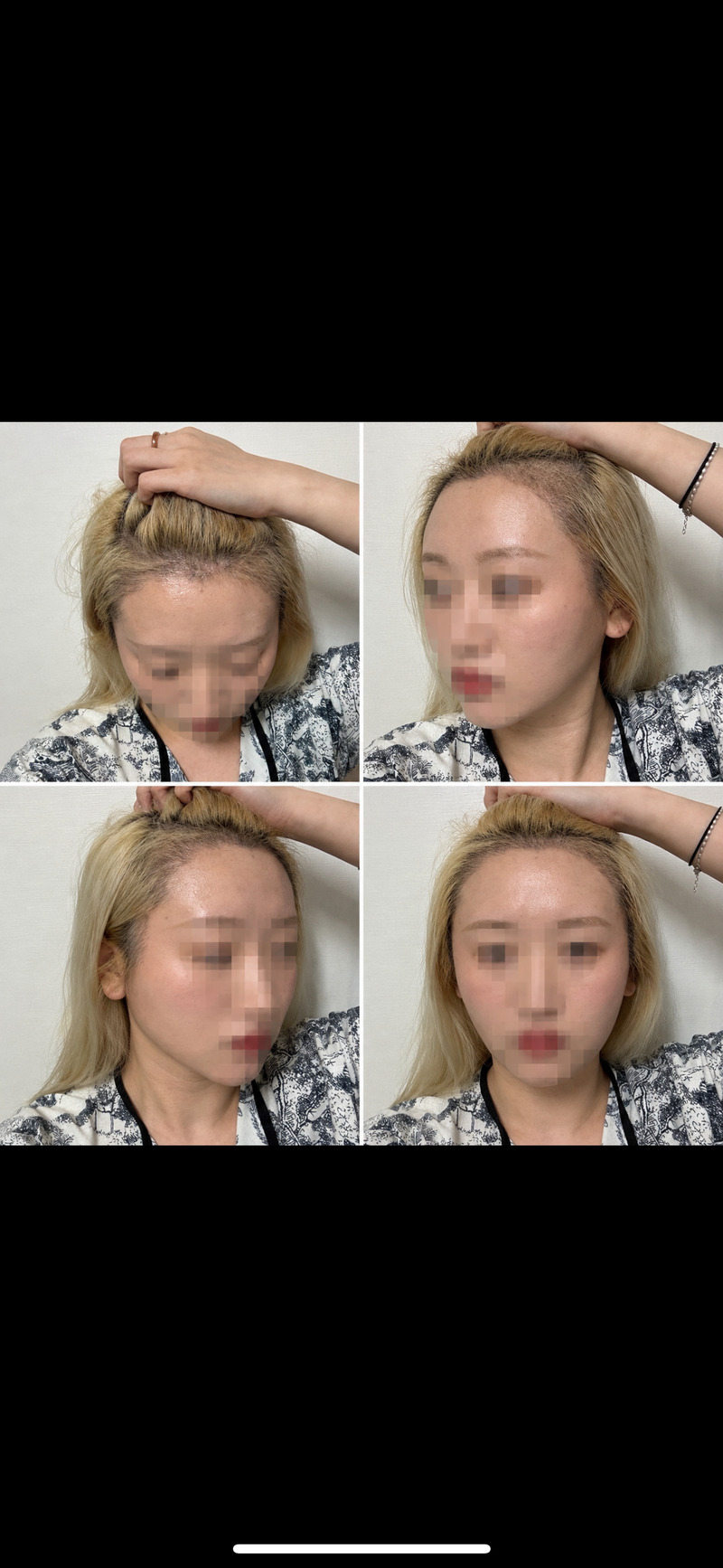 여자 삼개월차 수술후기