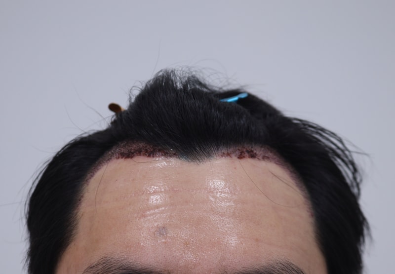 2. 수술후_1일_1.JPG