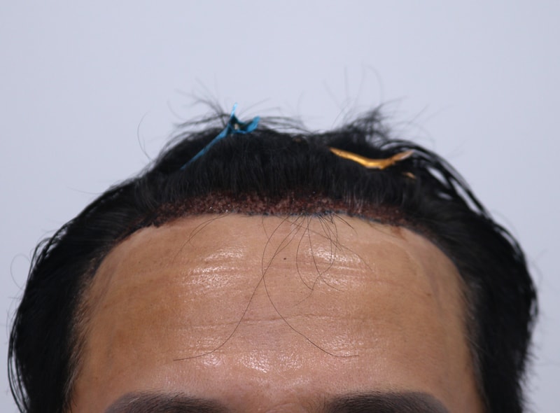 2. 수술후_1일_1.JPG