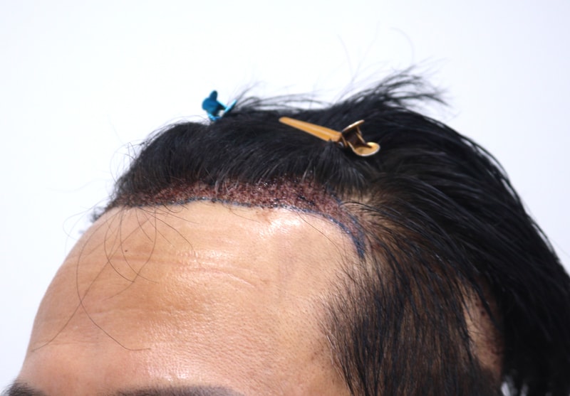 2. 수술후_1일_2.JPG