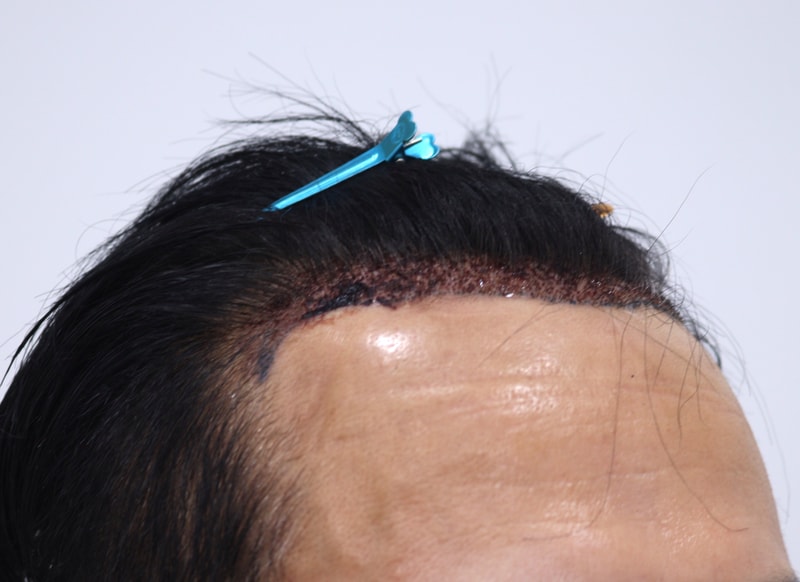 2. 수술후_1일_3.JPG