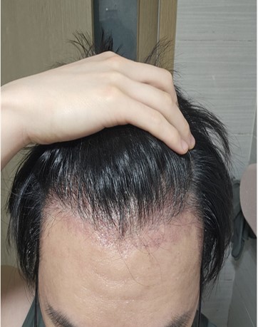 수술 2달차.jpg