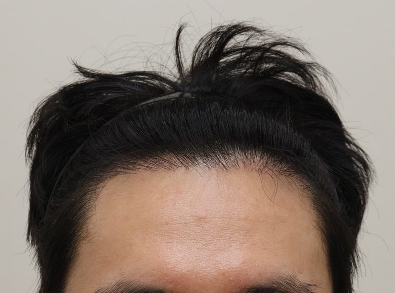 3. 수술후_6개월_1.JPG