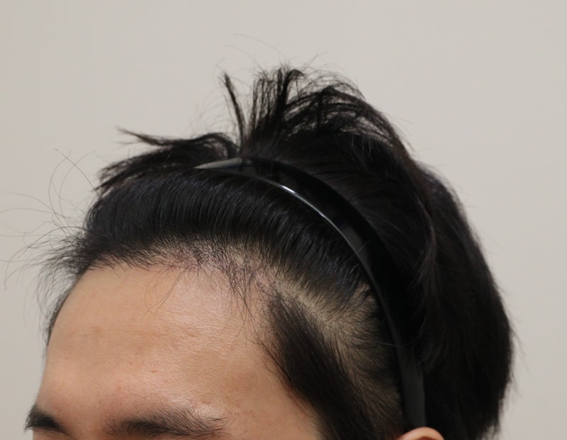 3. 수술후_6개월_2.JPG