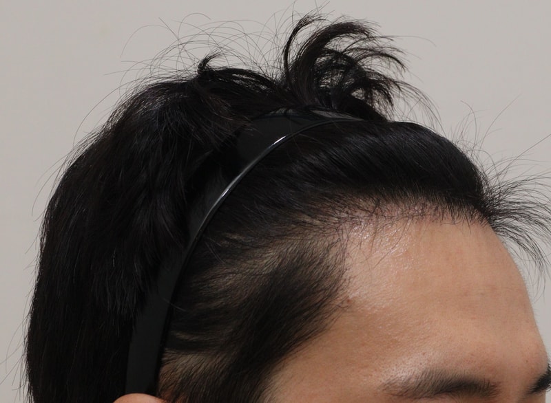 3. 수술후_6개월_3.JPG