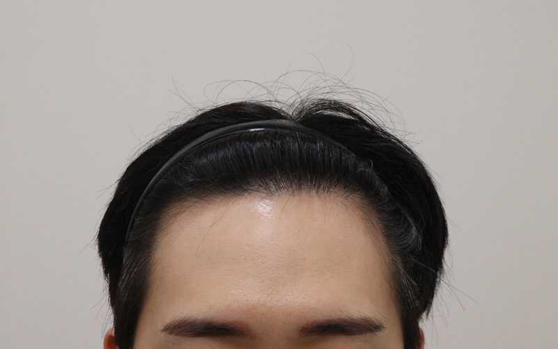 4. 수술후_1년_1.JPG