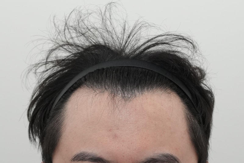 수술전.jpg