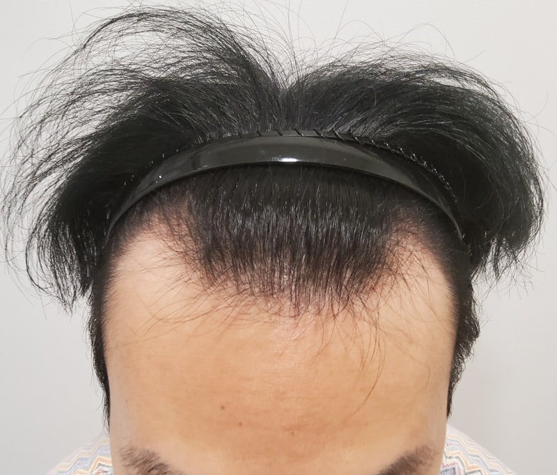 1. 수술전_2.jpg