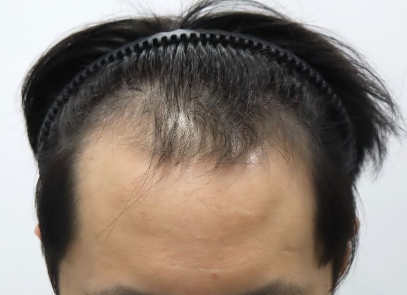 3.수술전.JPG