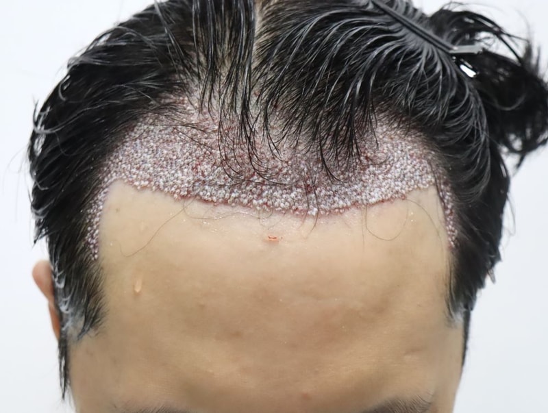 6.수술당일.JPG