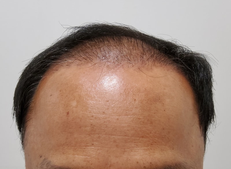 3. 수술후_3개월_1.jpg