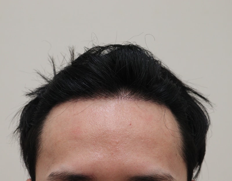 4. 수술후_1년_1.JPG