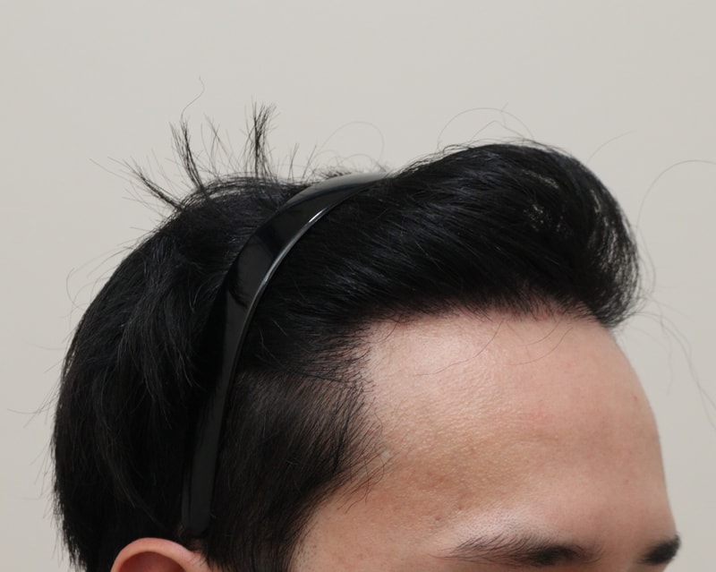 4. 수술후_1년_2.JPG