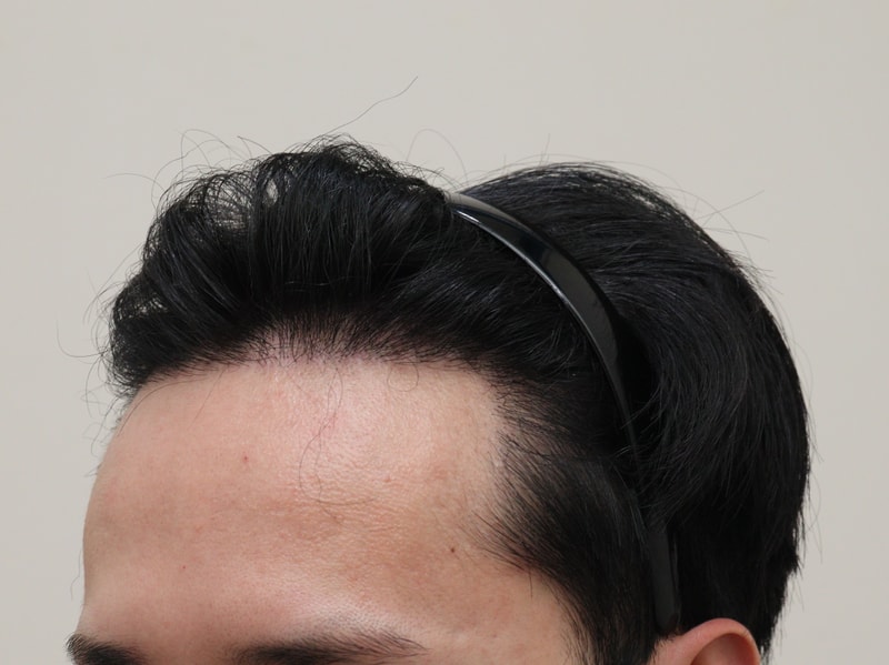 4. 수술후_1년_3.JPG
