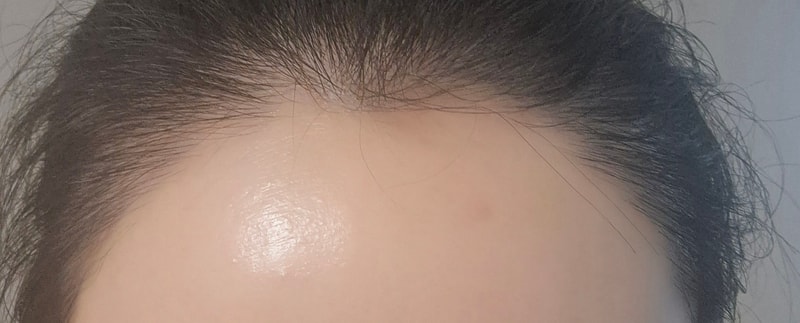 수술후.jpg