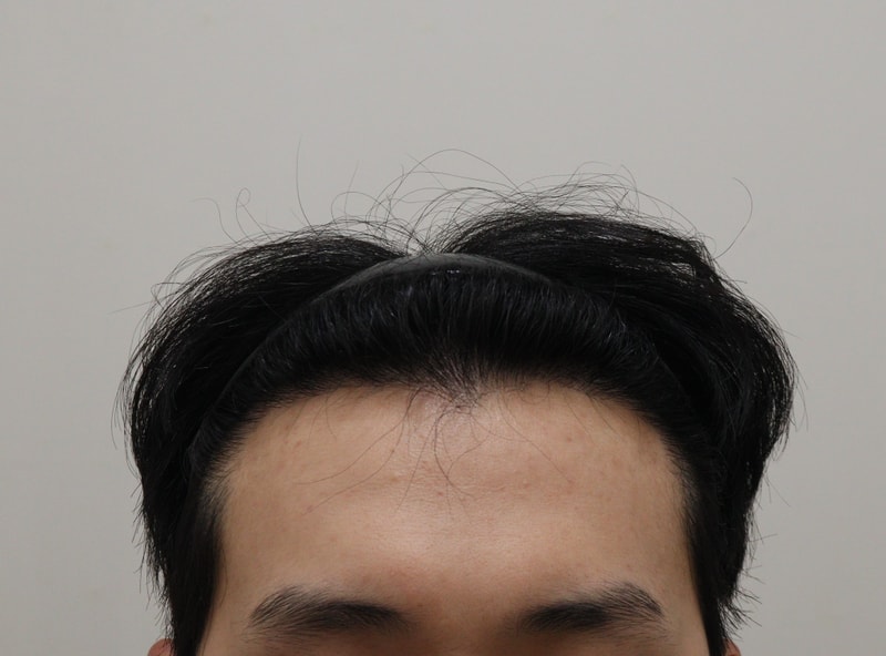 4. 수술후_1년_1.JPG