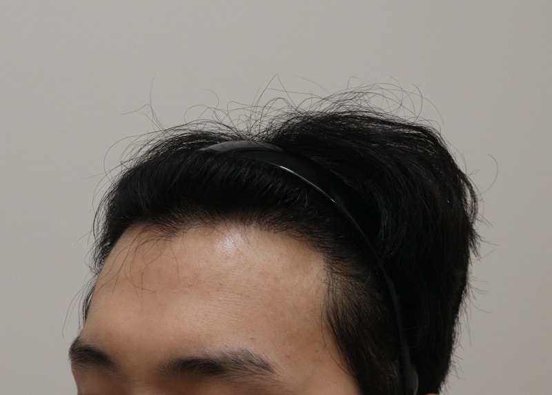4. 수술후_1년_2.JPG