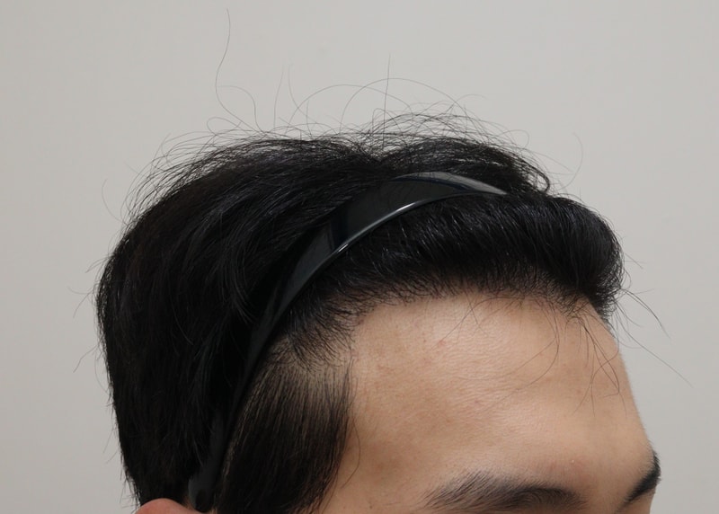 4. 수술후_1년_3.JPG