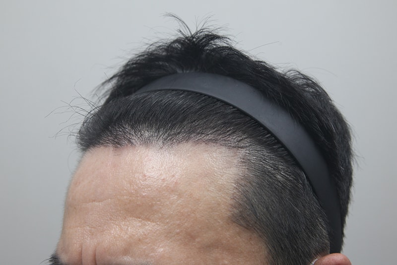 모나라모발이식 (2).jpg