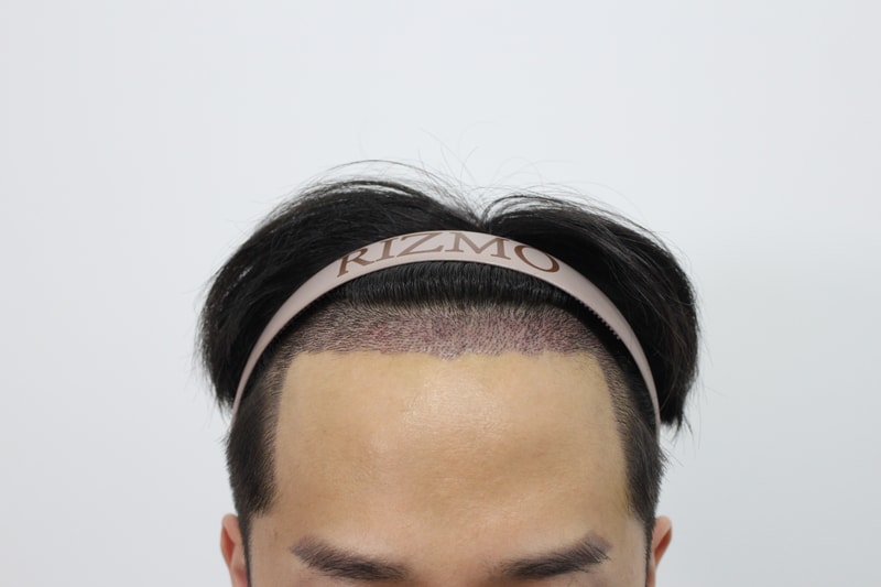 수술후2주1.jpg