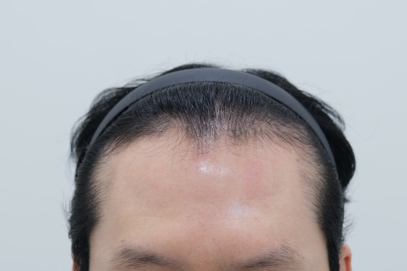 (연세모에버의원) 모발이식 2년 후 자신감 되찾았어요