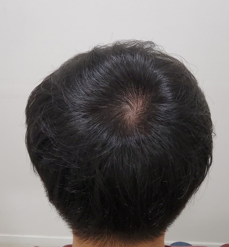 5. 수술후_1년_4.jpg