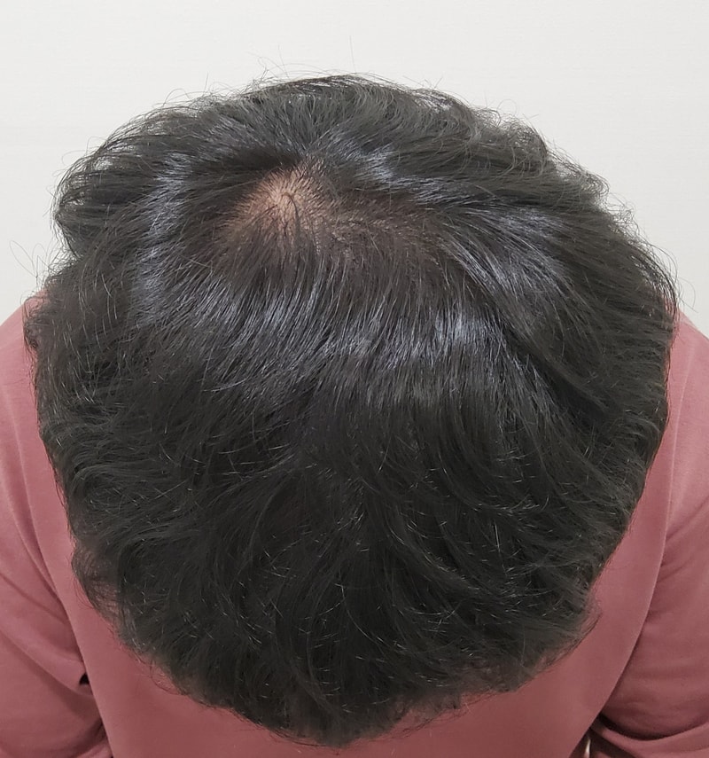 5. 수술후_1년_5.jpg