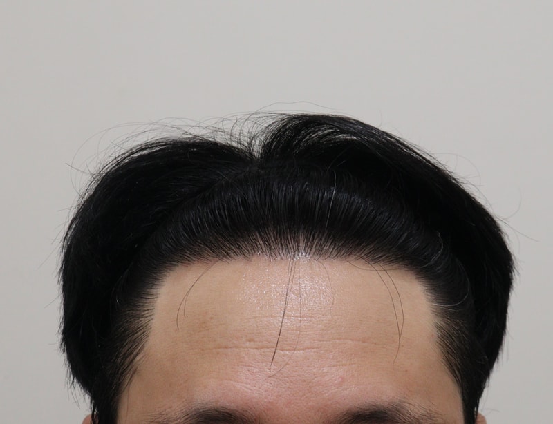 4. 수술후_1년_1.JPG
