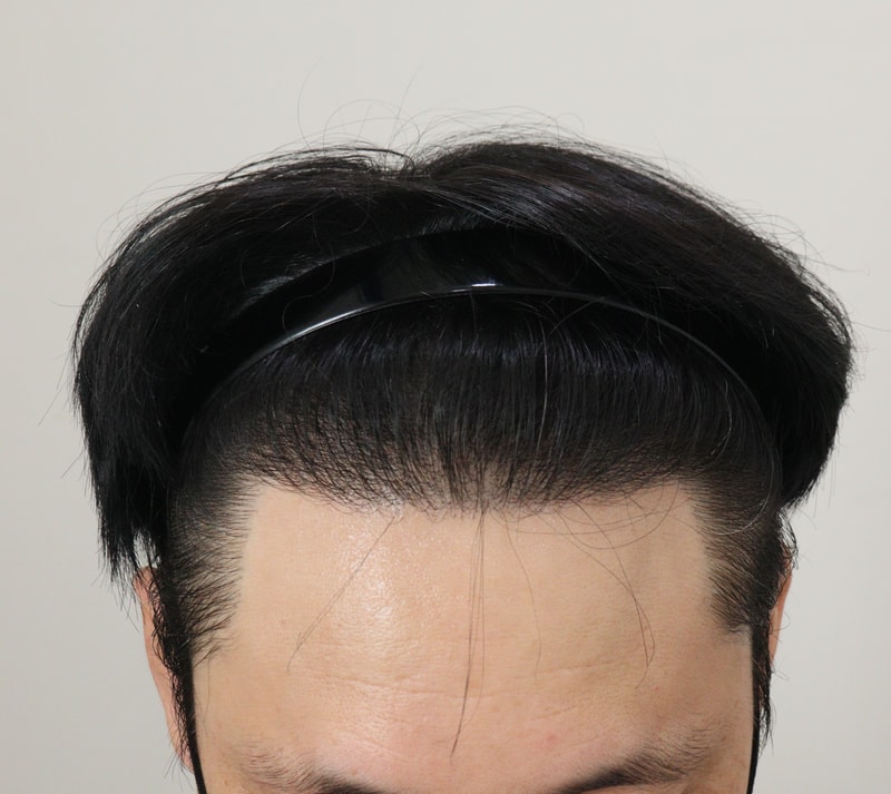 4. 수술후_1년_2.JPG