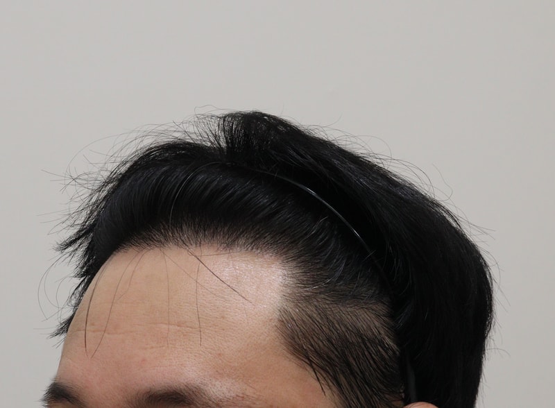 4. 수술후_1년_3.JPG