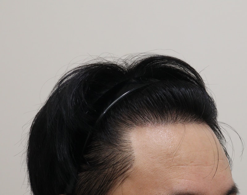 4. 수술후_1년_4.JPG