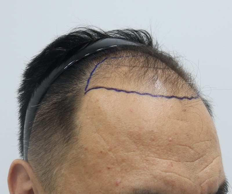 1. 수술전_3.JPG