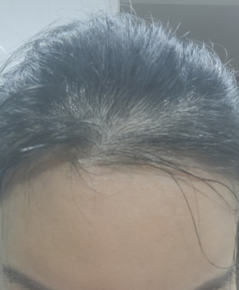 김현리_2주경과_셀프촬영 (3).jpeg