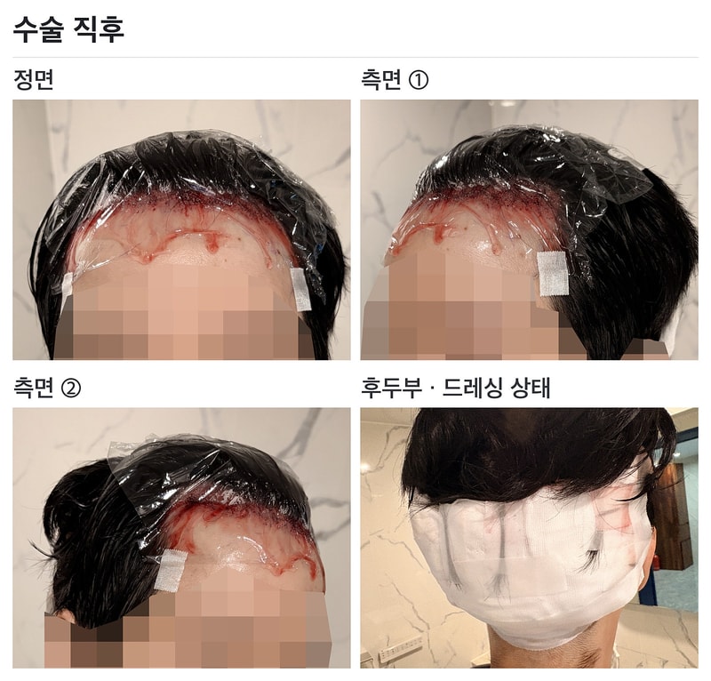 02_수술직후.jpg